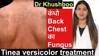 Tinea Versicolor Treatment | सेहुआ /करोडिया/सीप Tinea body fungus treatment