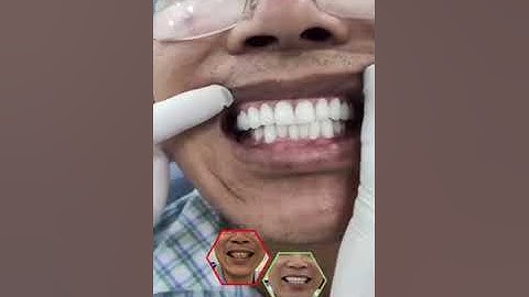 Cảm nhận của Anh Thắng sau khi bọc răng sứ tại Nha Khoa Khắc Ghi