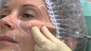 Clip Softfil Classic Precision