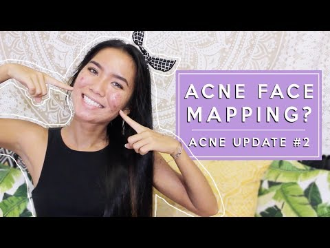 ACNE FACE MAPPING? Finding the True Cause of my Cystic Acne. Acne Update # | Michelle Kanemitsu