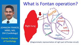 What is Fontan operation?