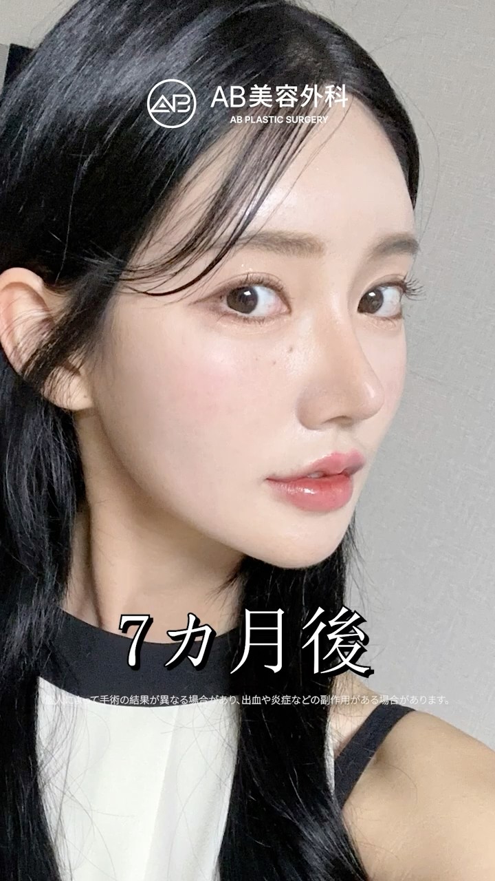 輪郭3点・目つき矯正・鼻整形で美人度アップ🤍 #Shorts