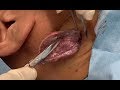 粉瘤atheroma,epidermal cyst　ブログでも詳しく解説してます。ふるばやし形成外科粉瘤クリニック東京新宿院　くりぬき法 大阪梅田形成外科クリニック