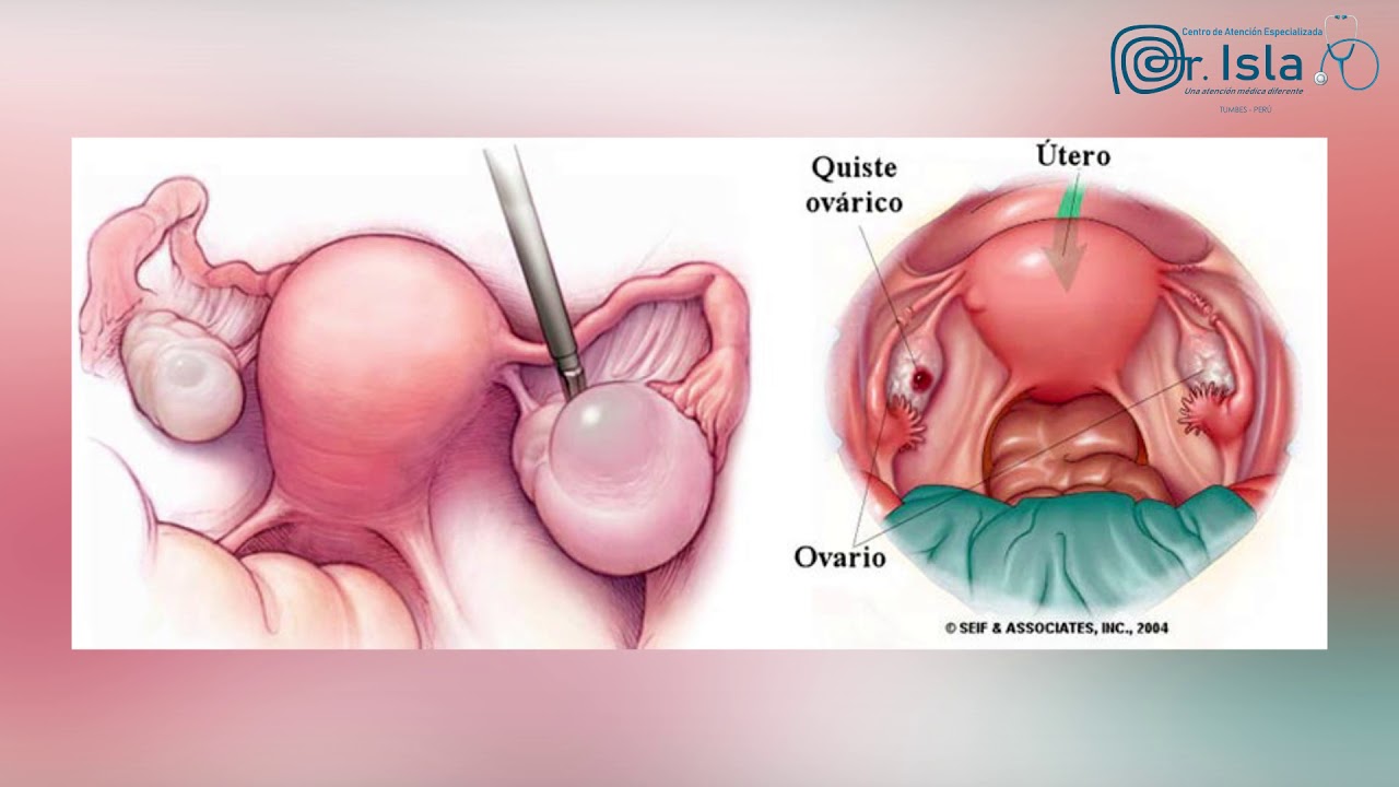 ¿QUE SON LOS QUISTES? Dr,Isla YouTube