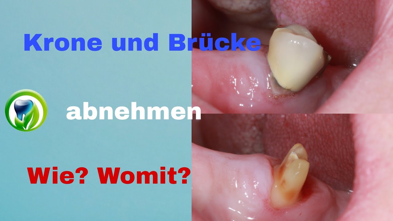 Wie bekommen wir die Krone oder Brücke vom Zahnstumpf runter? Krone heile oder Krone kaputt ...