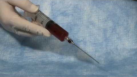 Harvest PRP Preparation of Autologous Platelet Concentrate