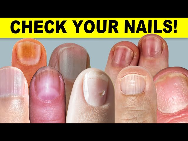 Your Nails Can Say a Lot About Your Health | University Hospitals