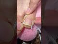 Ingrown Toenail Correction | Foot Care | Nail Treatment Shorts 👣