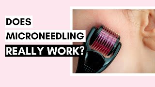Does Microneedling Really Work? | Treat acne scars, stretch marks, and wrinkles!