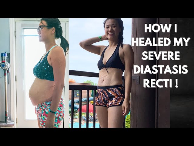 How I Healed My Large Diastasis Recti (2 times!) 