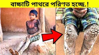 বাচ্চাটির পুরো শরীর পাথরে পরিনত হচ্ছে। মাথা ঘুরে যাওয়ার ফ্যাক্ট।। রহস্য রোমাঞ্চ।।