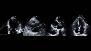 Valvular Emergencies Part 1  Diagnosis and Management of Severe Mitral Regurgitation Made Easy!
