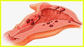 Видео Скудные месячные коричневого цвета... (автор: Счастливая жизнь)