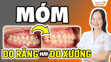 [Ca Thực Tế] Niềng Răng Móm Không Cần Phẫu Thuật - 5 Bước Lên Kế Hoạch Điều Trị