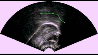 B voiceless palatal plosive half speed.avi