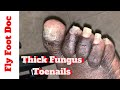 Thick Fungus Toenail Fun!|| How to trim fungus toenails