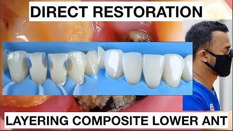 Step by step Layering Composite Lower Anterior | General Dentist Griya RR