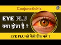 Eye Flu होने पर क्या करें ? | Conjunctivitis cause and treatment | Sedative Doctor