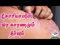    solutions for psoriasis all skin diseases