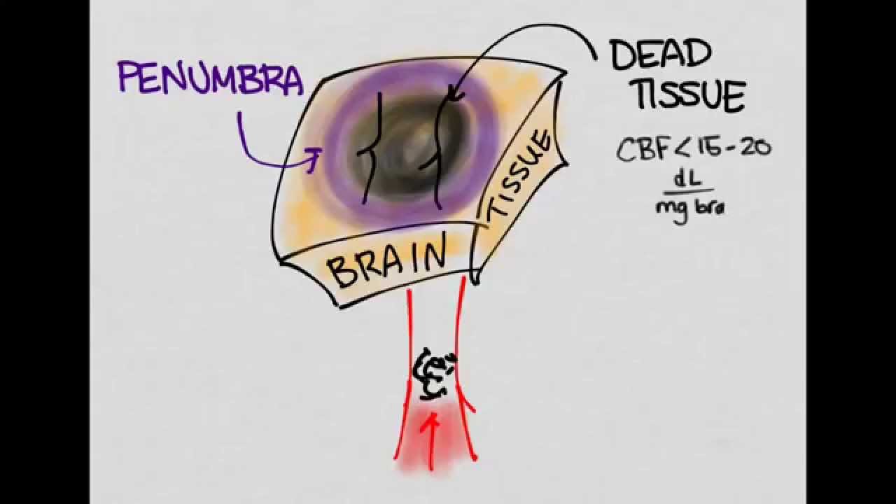 Ischemic Stroke 01: Introduction