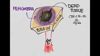 Ischemic Stroke 01: Introduction