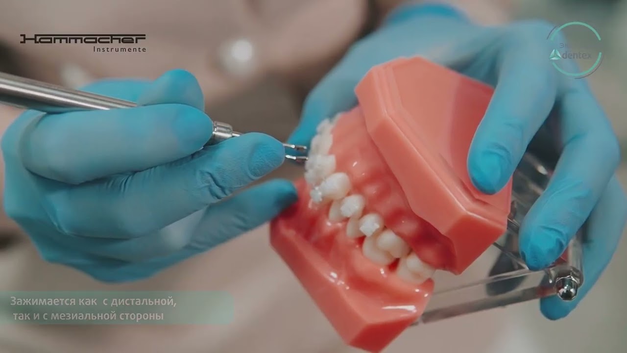 Применение ортодонтического лигатурного директа, или такера Hammacher на практике