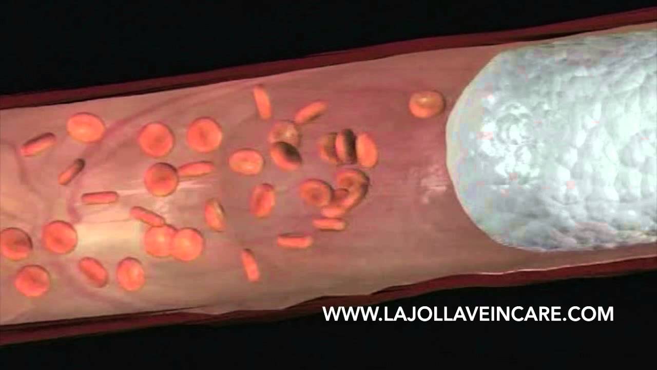 Foam Sclerotherapy Procedure Video 4 YouTube player