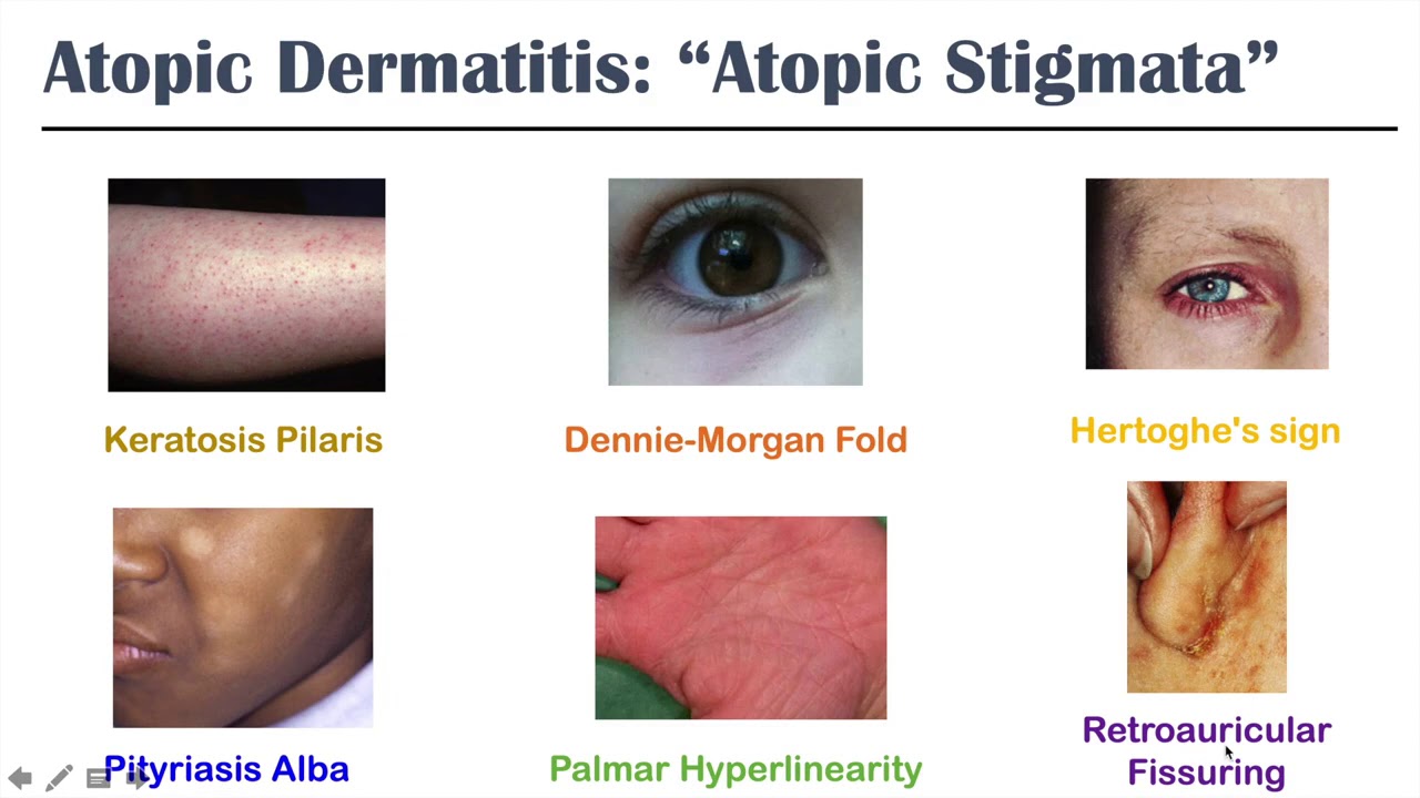 Eczema Atopic Dermatitis - YouTube