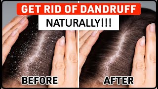 How to get rid of Dandruff l Remedies To Cure Dandruff Naturally l How to treat dandruff !