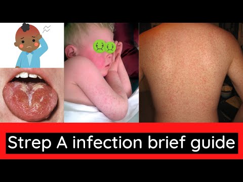 Wideo: 3 sposoby, aby dowiedzieć się, czy Twoje dziecko ma szkarlatynę