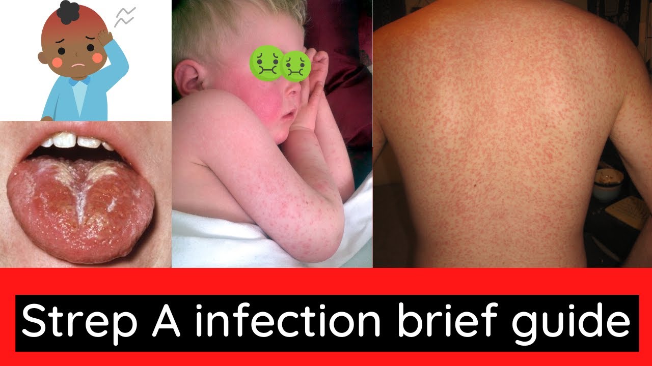 Understanding Scarlet Fever: Causes, Symptoms & Treatment — Eightify