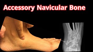 Accessory Navicular Bone: Causes, Symptoms, and Treatment Explained