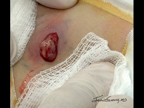 Fargo Flank Abscess Drain & Pack!
