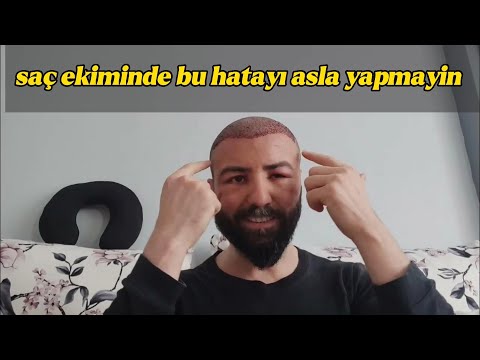 saç ekiminde bu hatayı asla yapmayın.