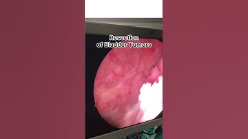 Endoscopic Removal of Bladder Tumor