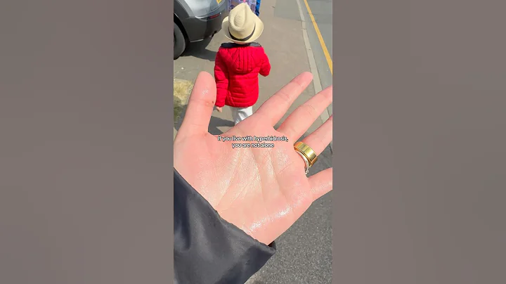 Do you suffer from excessively sweaty hands or feet? #hyperhidrosis