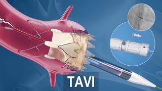 Tavi̇ Kalp Kapağının Ameliyatsız Yöntemle Değiştirilmesi