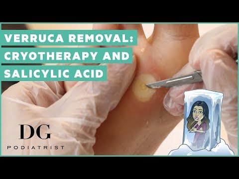Verruca removal cryotherapy and salicylic acid