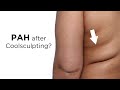 Considering Coolsculpting? Paradoxical adipose hyperplasia(PAH) “growing” concern | Plastic Surgeon