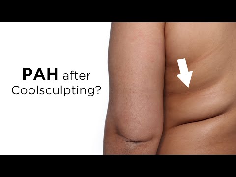 Considering Coolsculpting? Paradoxical adipose hyperplasia(PAH) “growing” concern | Plastic Surgeon