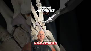 Most Painful Hand Condition 👍 Thumb Arthritis #shorts