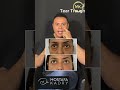 Eye Filler - الفيلر لعلاج خفسات العين