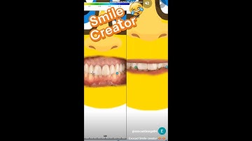 Exocad Smile creator 😂😂