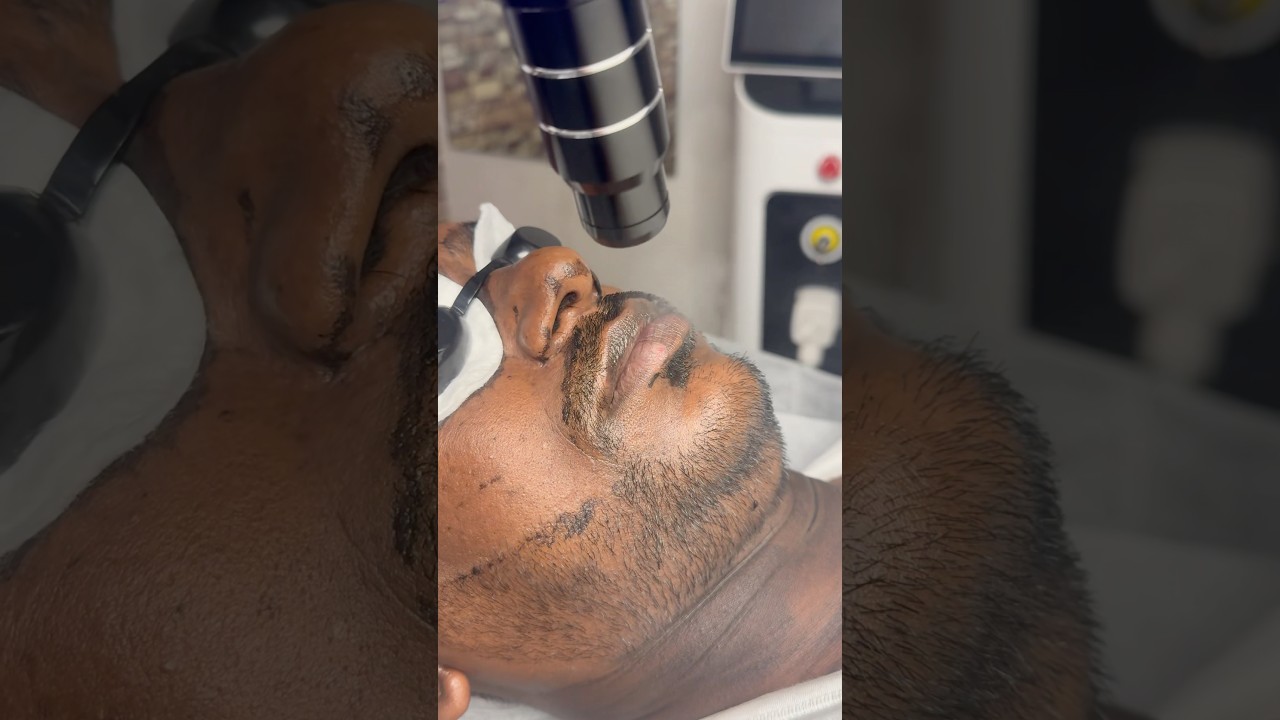 # Carbon Laser Treatment # Pradeep Skin care Chennai Kundrathur cell 9710211259 ￼