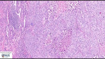 Lung squamous cell carcinoma Microscopy - Talking slide