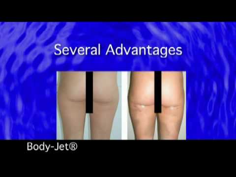 Body-Jet Lipo in West St. Louis County, MO.mpeg