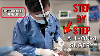 *Explicit* StepbyStep Allon4 Surgery: Expert Techniques Revealed. Pterygoid, Trans Sinus