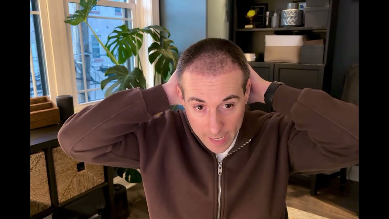 One month check-in post hair transplant at the Cosmedica Clinic in Istanbul with Dr. Acar