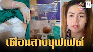 สาวเตือนภัยสายบุฟเฟต์เป็นนิ่วในถุงน้ำดี ปวดท้องหนักนับเดือน | ข่าวเที่ยงอมรินทร์ | 16 มี.ค.66