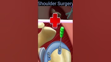 Shoulder fracture surgery | Shoulder fracture surgery recovery #shoulderpain #surgery #shorts